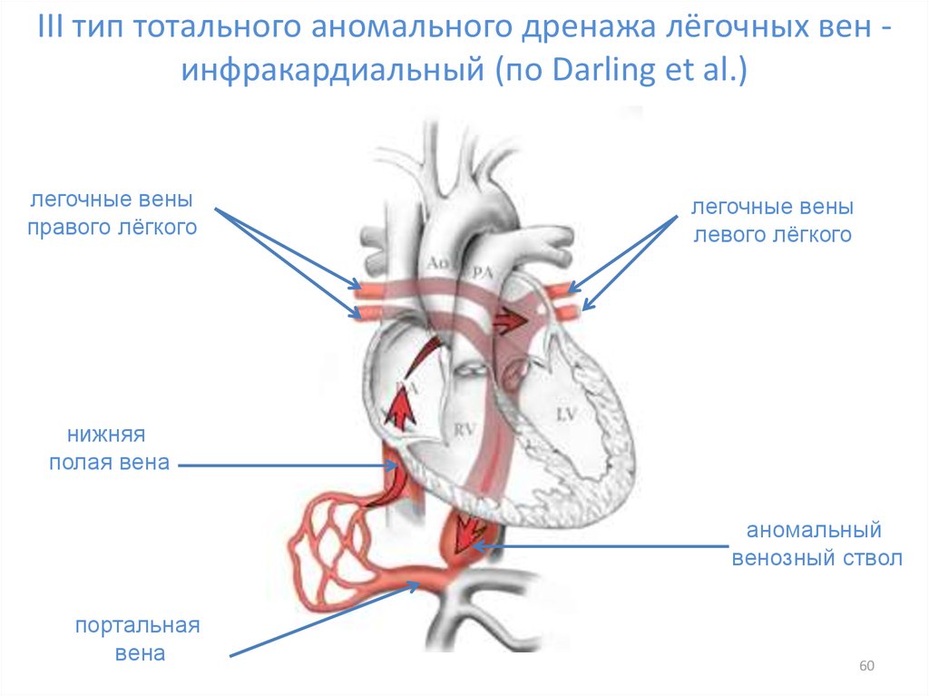 Врожденный венозный порок. Инфракардиальный аномальный дренаж легочных вен. Аномалии впадения легочных вен. Тотальный аномальный дренаж легочных вен. Частичный аномальный дренаж легочных вен.