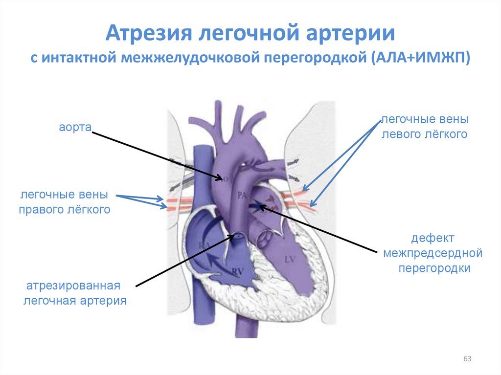 Легочных артериях легочных венах. Атрезия легочной артерии с интактной межжелудочковой перегородкой. Стеноз легочной артерии с интактной межжелудочковой перегородкой. Атрезия легочной артерии. Атрезия клапана легочной артерии 1 типа.