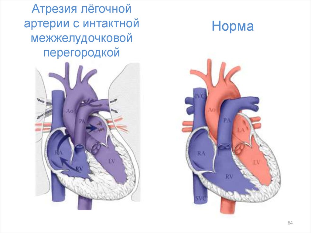 Тетрада фалло гемодинамика схема