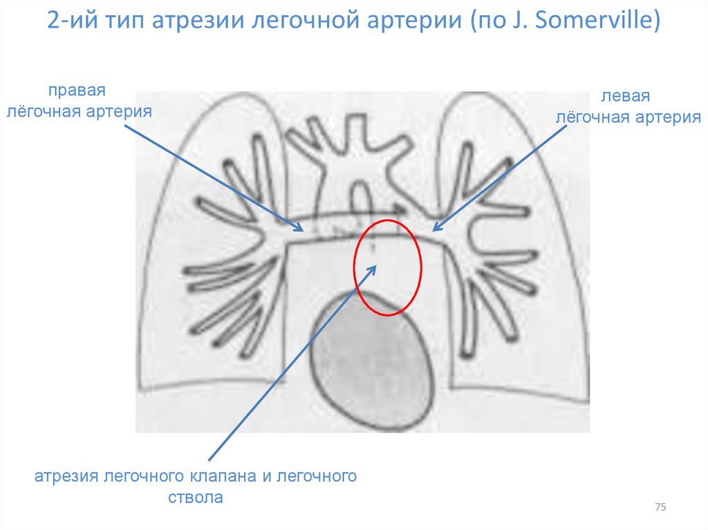 Для легочной артерии характерно. 3 Легочные артерии. Атрезия легочной артерии 2 Тип. Бандинг легочной артерии. Атрезия легочной артерии по Сомервилль.