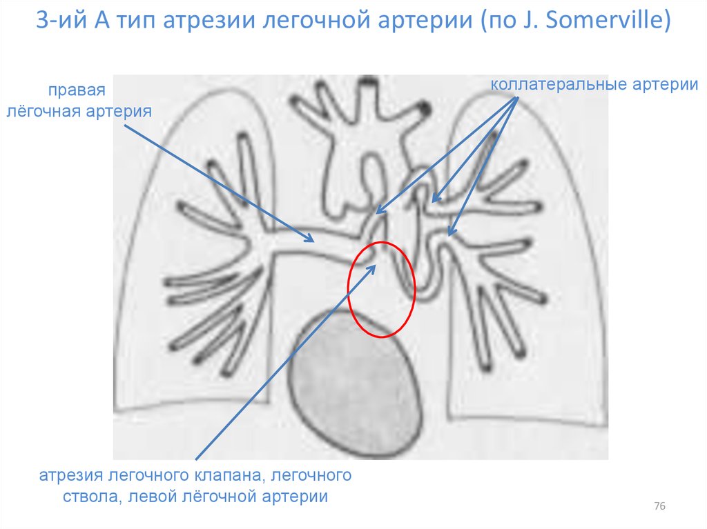 Легочная артерия тип. Атрезия легочной артерии 4 Тип. Атрезия легочной артерии классификация. Типы атрезии легочной артерии. Атрезия клапана легочной артерии.