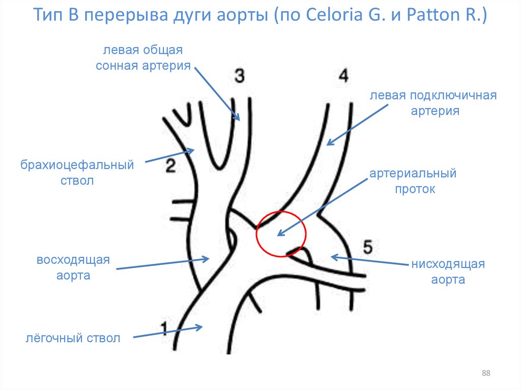 Правая аберрантная артерия. Типы перерыва дуги аорты. Сегменты подключичной артерии. Артерии дуги аорты анатомия. Плечеголовной ствол аорты.
