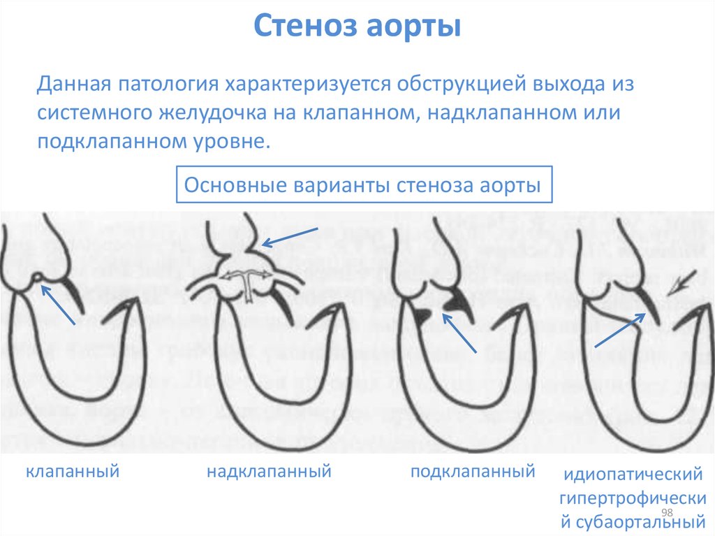 Причины стеноза аортального клапана. Надклапанный аортальный стеноз. Врожденный стеноз аорты. Надклапанный стеноз аорты. Клапанный подклапанный стеноз аорты.