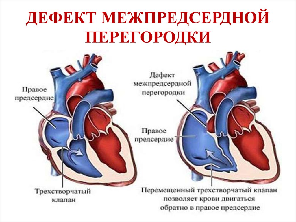 1 3 окно в сердце. Врожденный порок сердца ДМПП. ВПС дефект межпредсердной перегородки. ВПС вторичный дефект межпредсердной перегородки. Врожденный порок сердца дефект межпредсердной перегородки.