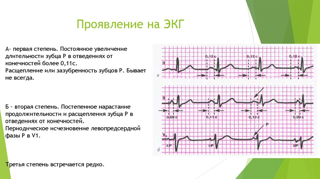 Презентация экг для студентов