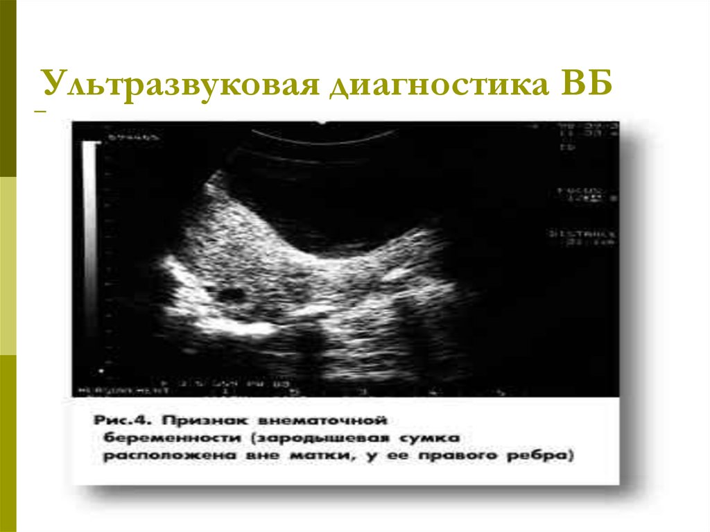 Тянет яичник при беременности на ранних. Шеечная внематочная беременность УЗИ. Внематочная беременность в яичнике на УЗИ. Интерстициальная беременность по УЗИ. УЗИ при апоплексии яичника.