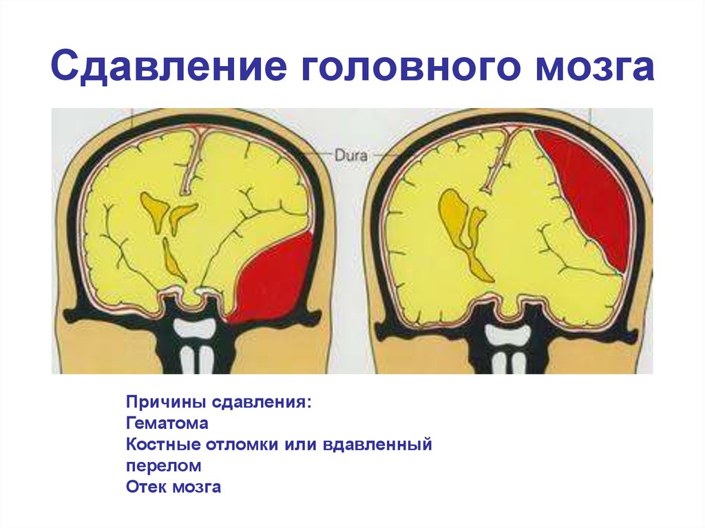 Сдавление мозга признаки. Травматическая компрессия головного мозга. Сдавление головного мозга. Давление головного мозга. Сдавление головного мозга гематомой.
