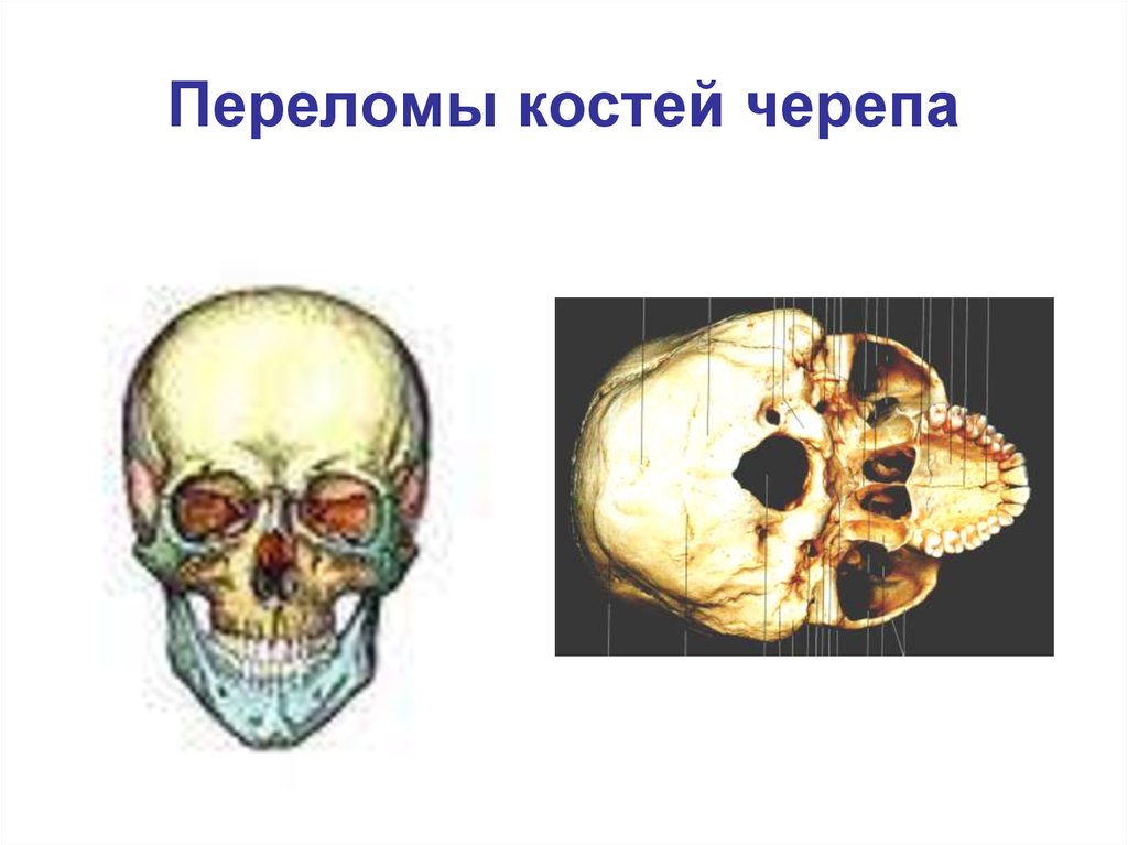 Переломы костей черепа