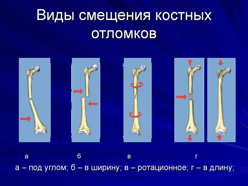 Переломы бывают. Смещение костных отломков при переломах. Краниальное смещение отломков. Виды смещения костных отломков при переломе. Поперечный перелом со смещением отломков по ширине.