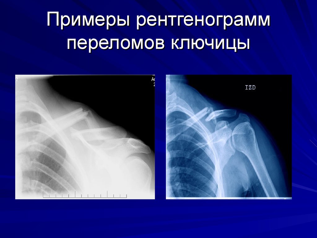 Примеры рентгенограмм переломов ключицы