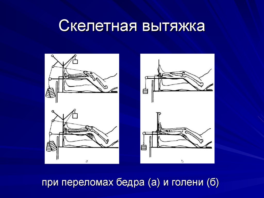 Вытяжение голени. Скелетное вытяжение шейки бедра. Перелом бедра скелетное вытяжение. Скелетная вытяжка при переломе. Вытяжка при переломе бедра.