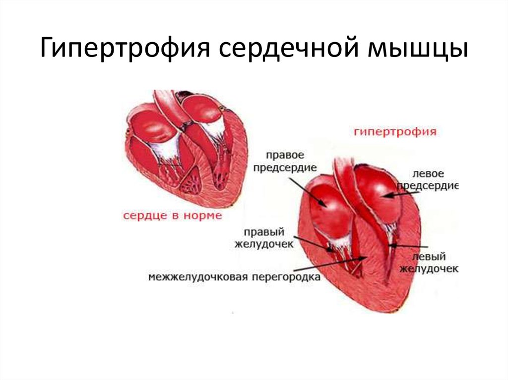 Изменения миокарда левого желудочка сердца