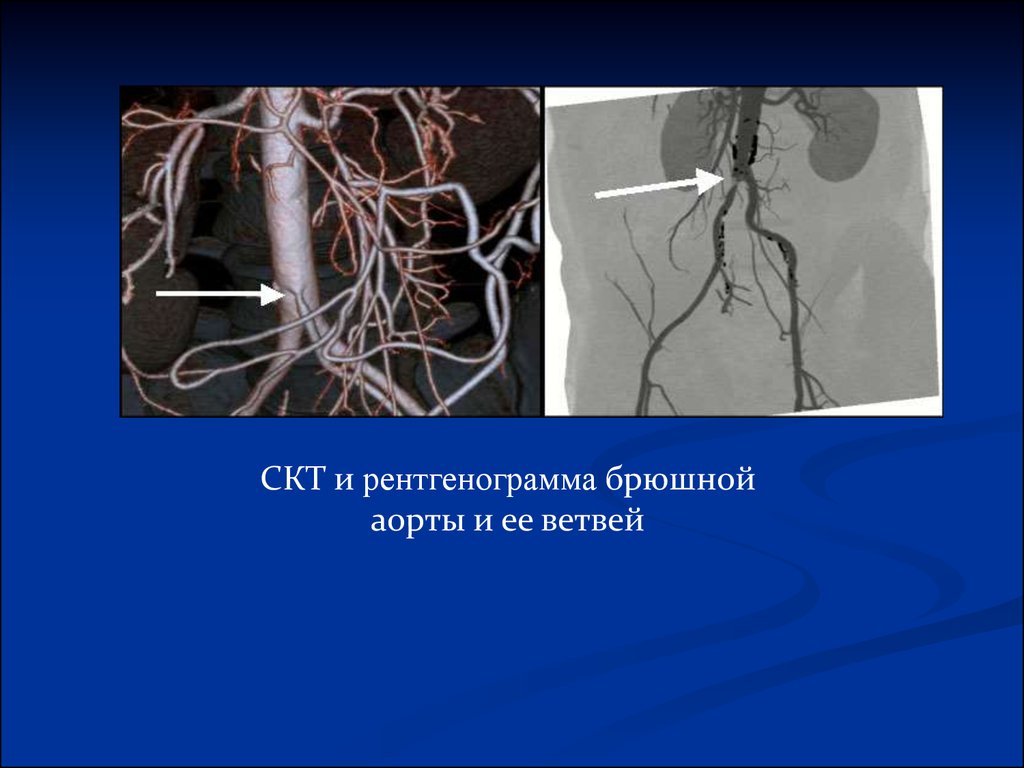 Тромбоз брюшной полости. Ангиография сосудов брюшной аорты. Кт ангиография брюшной аорты. Ангиография чревного ствола.