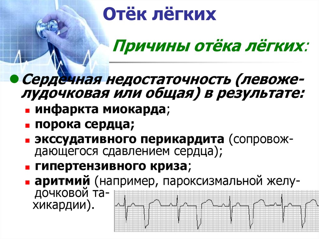 Экг при отеке легких фото