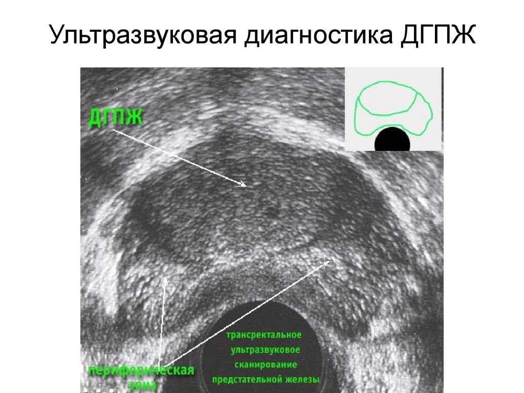 Гиперплазия предстательной железы картинки