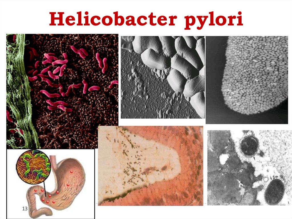 Язва желудка бактерия. Хеликобактер пилори возбудитель. Бактерии хеликобактер пилори микроскопия. Хеликобактер пилори в желудке. Бактерия вызывающая гастрит и язву желудка.