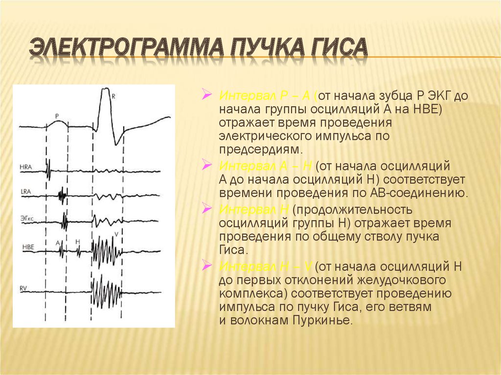 Пучка гиса на экг. Осцилляции на ЭКГ. Электрограмма. Пучок Гиса фото. Электрограмма в ЭКГ.