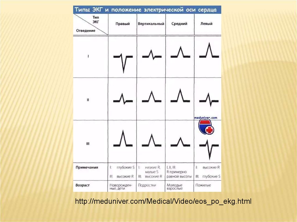 Вертикальное положение эос. Электрическая ось сердца на ЭКГ. Положение электрической оси сердца на ЭКГ. ЭОС В ЭКГ расшифровка. ЭКГ медунивер.