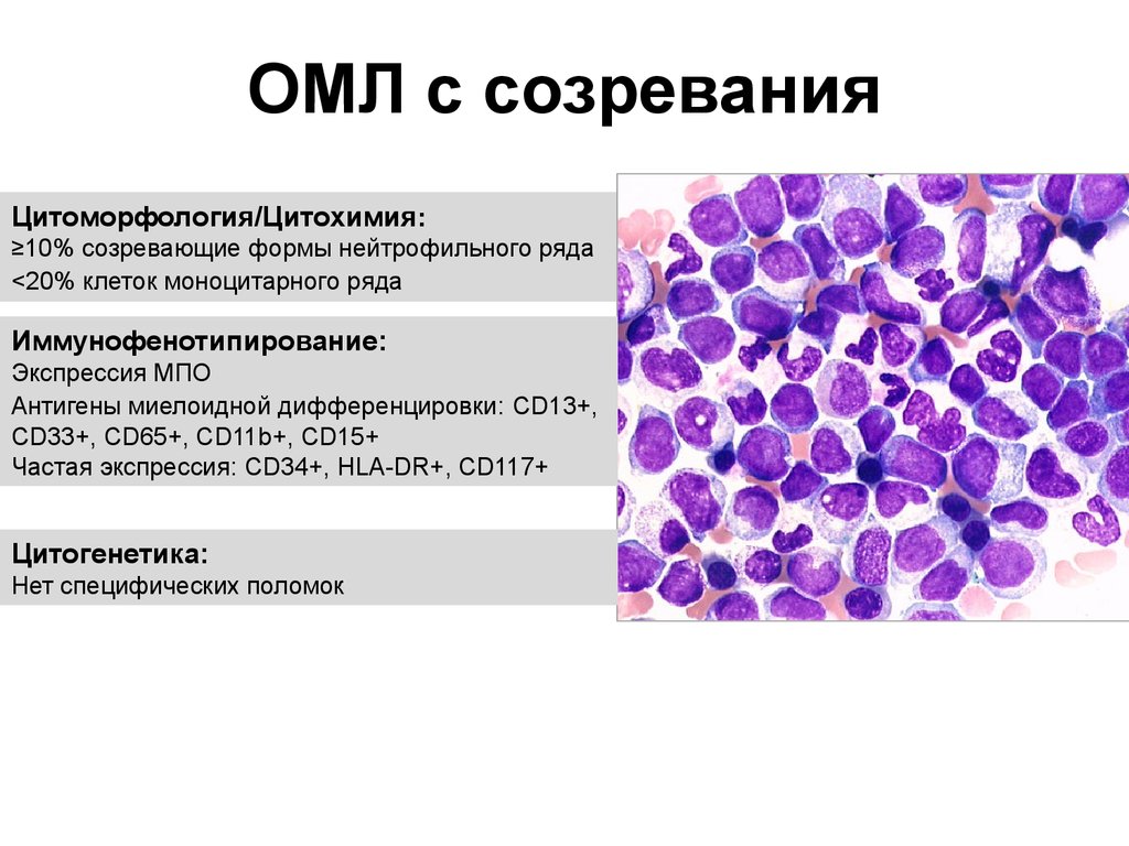 Картина крови при остром лейкозе