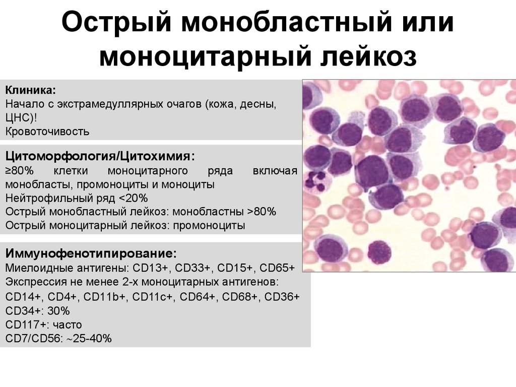 Изменение клеток крови. Хронический моноцитарный лейкоз показатели крови. Острый мегакариобластный лейкоз картина крови-. Острый моноцитарный лейкоз анализ крови.