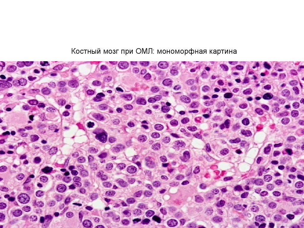 Острый лейкоз мозга. Острый миелобластный лейкоз гистология. Хронический миелоидный лейкоз гистология. Хронический миелолейкоз костный мозг макропрепарат. Хронический миелобластный лейкоз костный мозг гистология.