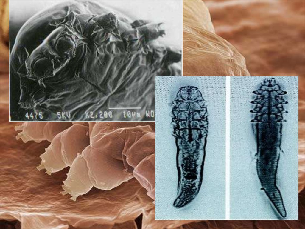 Demodex. Клещ демодекс под микроскопом на коже.