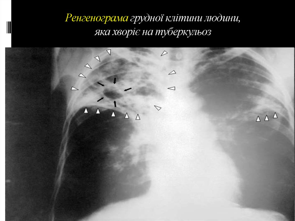 Ренгенограма грудної клітини людини, яка хворіє на туберкульоз
