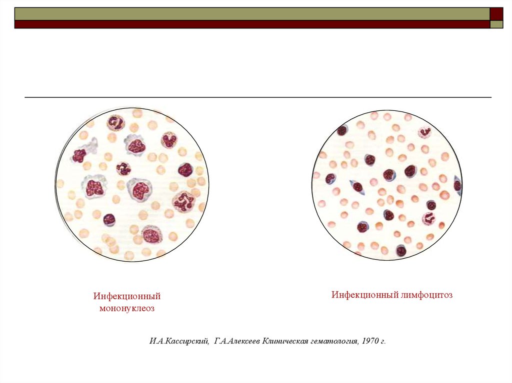 Инфекционный мононуклеоз. Клиническая гематология Кассирский Алексеев 1970. Инфекционный мононуклеоз гематология. Кассирский клиническая гематология.