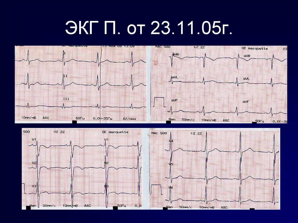 P на экг. Нет p на ЭКГ. Готический p ЭКГ. Расслоение p на ЭКГ. D24 в ЭКГ.