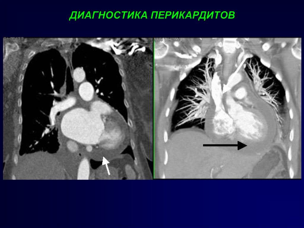 Выпотной перикардит. Экссудативный перикардит мрт. Экссудативный перикардит кт. Выпотной перикардит рентген.