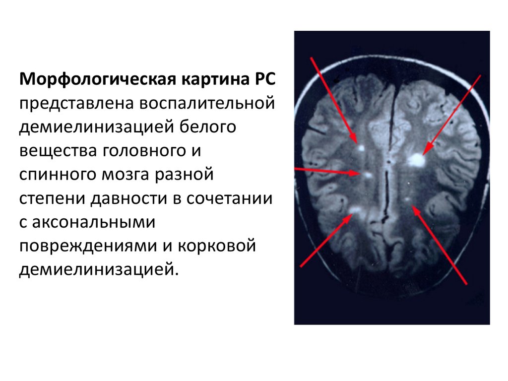 Демиелинизация головного. Рассеянный склероз спинного мозга. Очаги склероза в головном мозге. Концентрический склероз.
