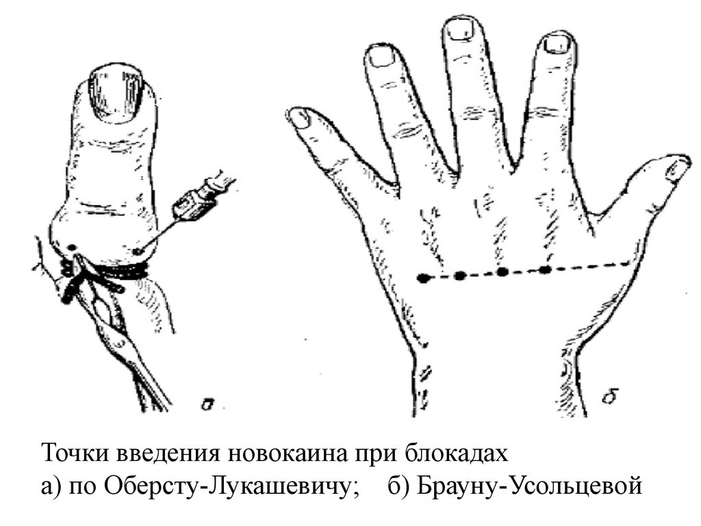 Анестезия по брауну