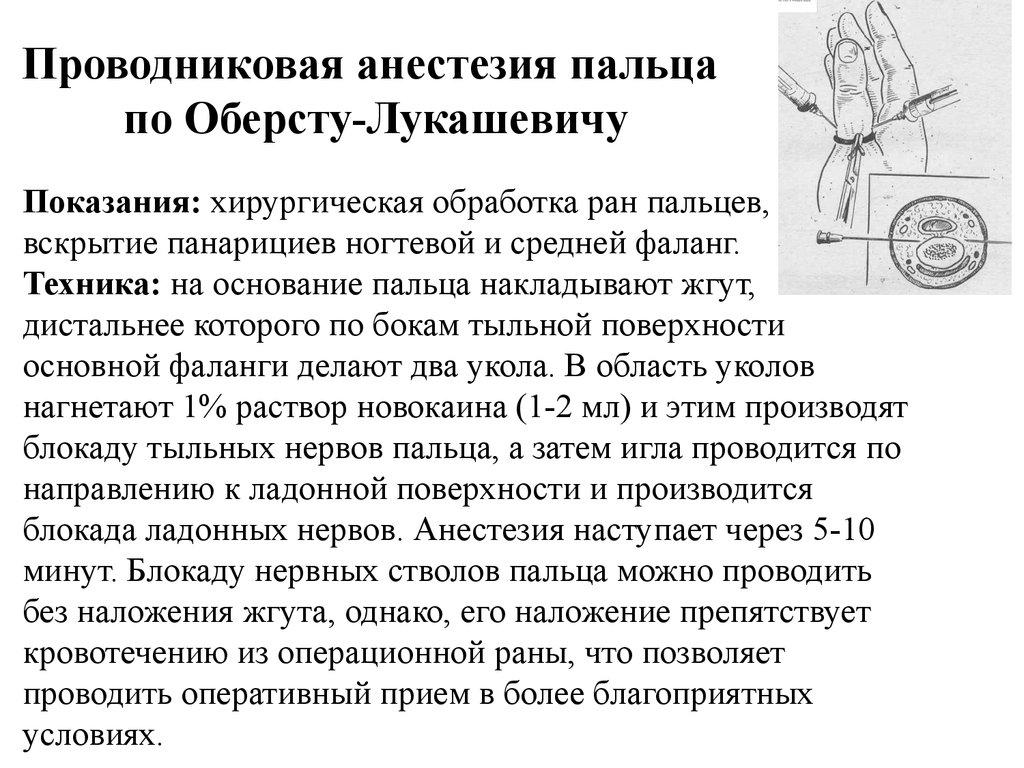 Проводниковая анестезия пальца по Оберсту-Лукашевичу