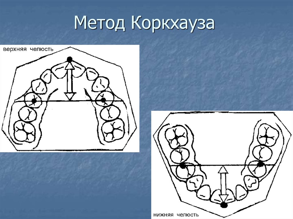 Таблица пона. Метод Коркхауза ортодонтия таблица. Метод Коркхауза в ортодонтии. Метод Коркхауза на нижней челюсти. Аппарат Коркгауза ортодонтия.