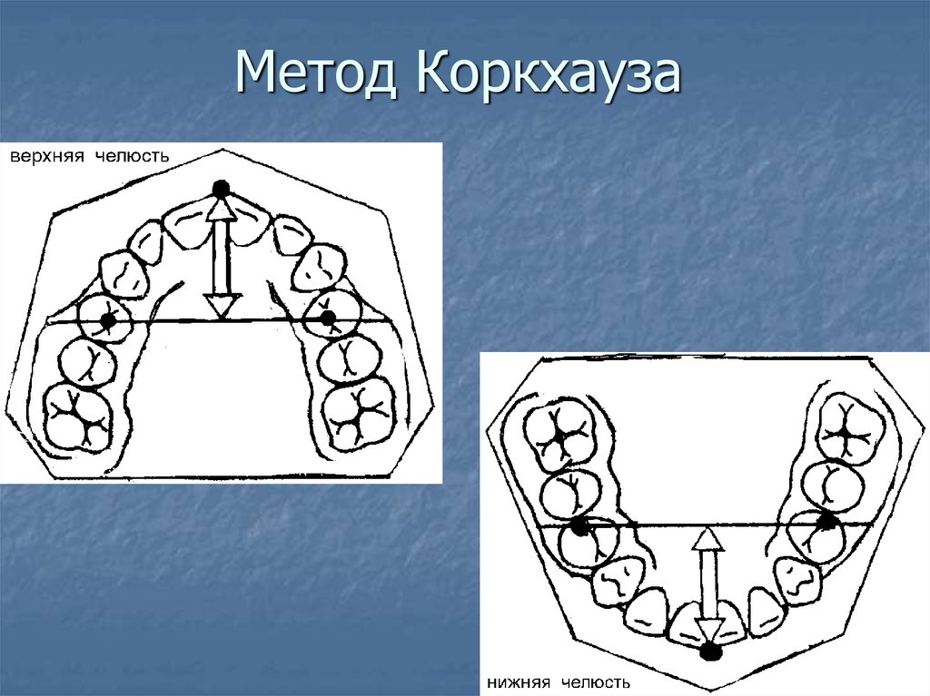 Хаулей гербер гербст. Метод Коркхауза в ортодонтии. Метод Коркхауза ортодонтия таблица. Метод Коркхауза на нижней челюсти.