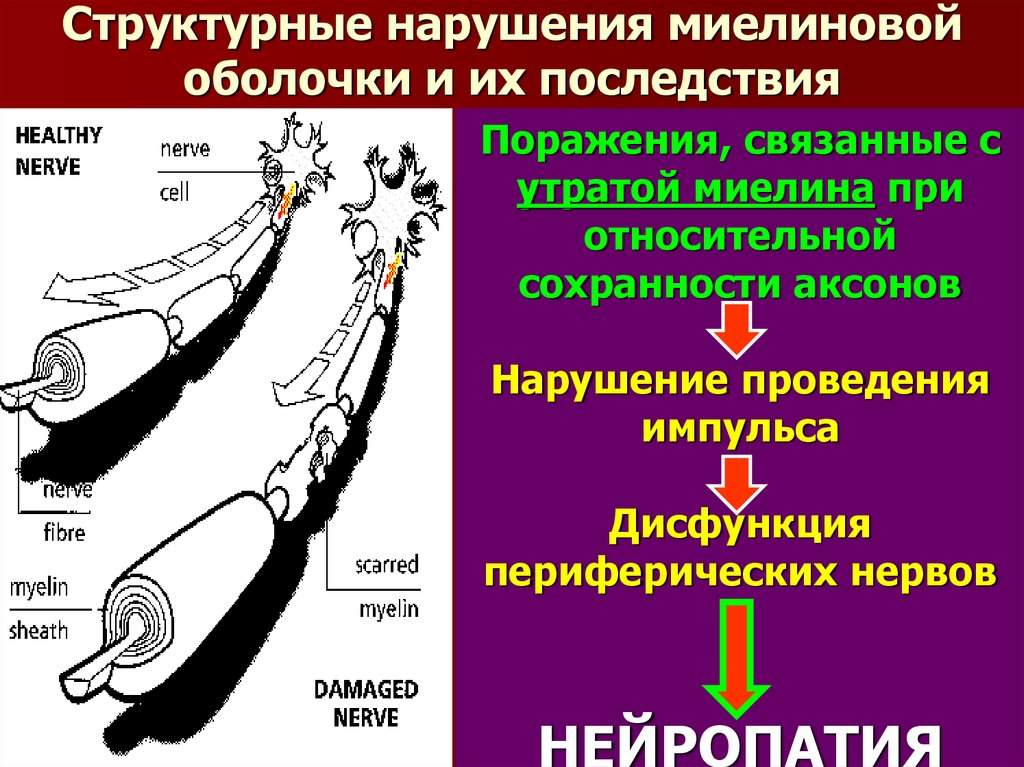 Структурные нарушения. Миелиновая оболочка нерва. Заболевания миелиновой оболочки. Разрушение миелиновой оболочки. Нарушение миелиновой оболочки.