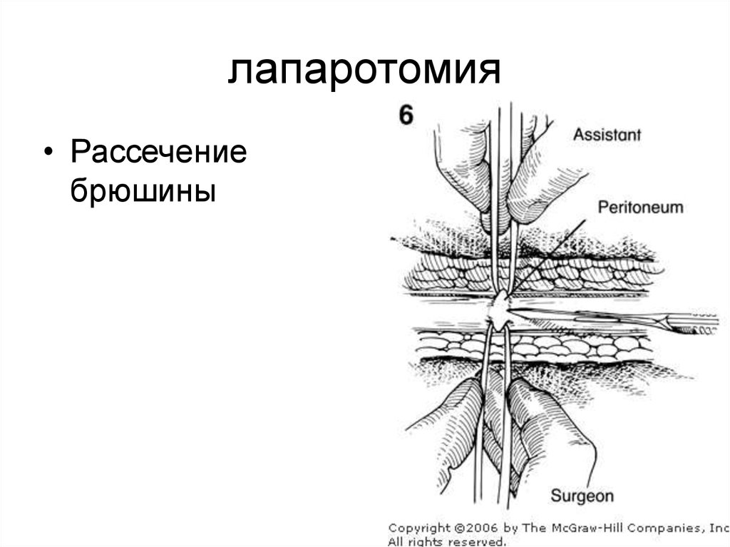 Какое лапаротомия. Нижнесрединная лапаротомия разрез. Срединная лапаротомия доступ. Верхняя срединная лапаротомия. Лапаротомия в акушерстве.
