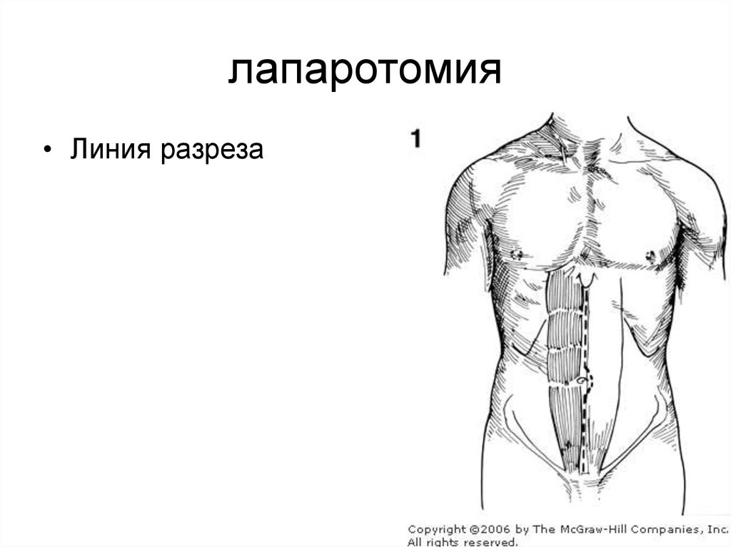 Нижняя лапаротомия. Срединная лапаротомия; параректальная лапаротомия.. Нижнесрединная лапаротомия. Средне Нижне срединная лапаротомия. Продольные разрезы лапаротомия.