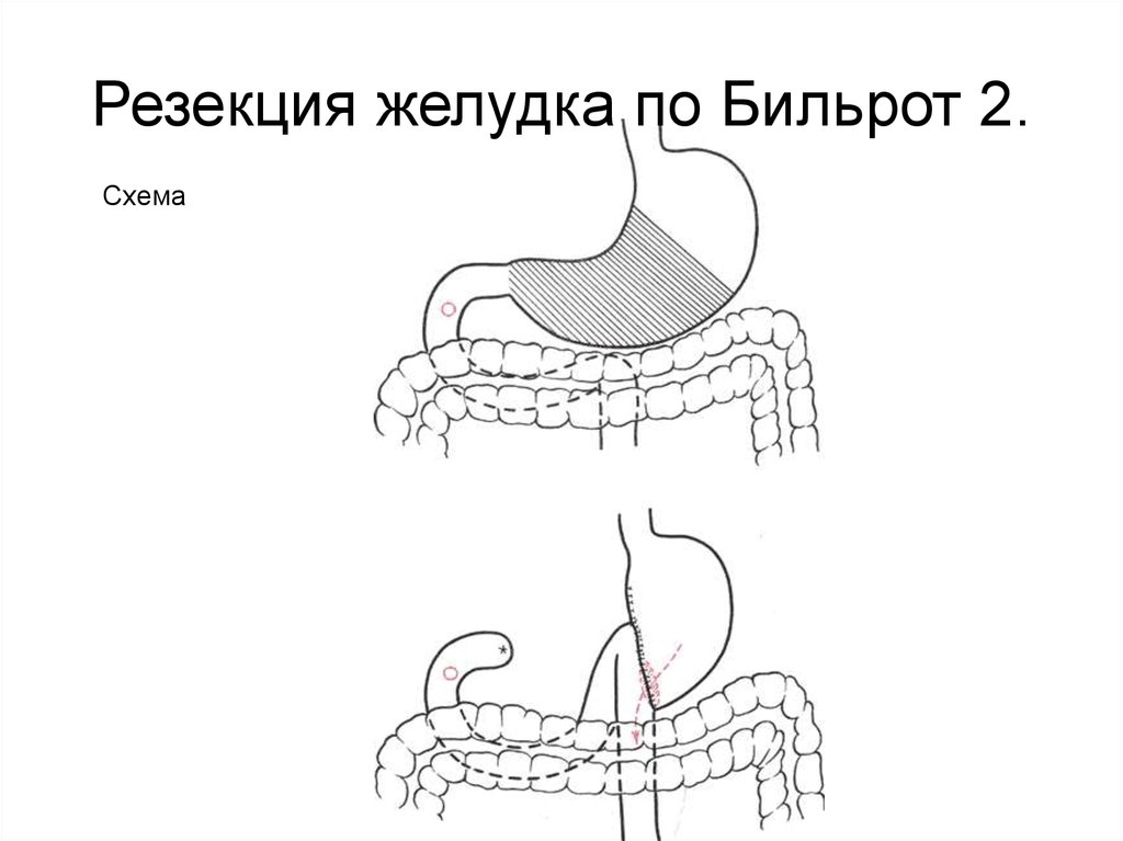 Резекция желудка по витебскому схема операции