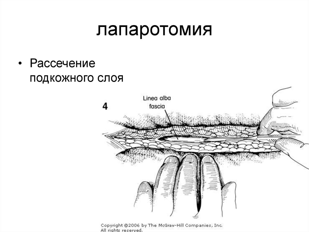 Нижняя лапаротомия. Рассечение лапаротомия. Нижнесрединная лапаротомия.