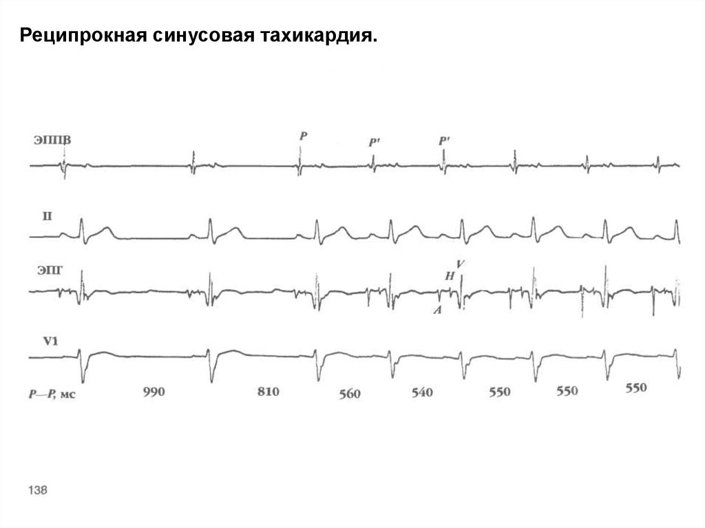 Синусовая тахикардия. Синусовая реципрокная тахикардия ЭКГ. Синоатриальная реципрокная тахикардия на ЭКГ. Синоатриальная (синусовая) реципрокная пароксизмальная тахикардия. Синоатриальная тахикардия на ЭКГ.