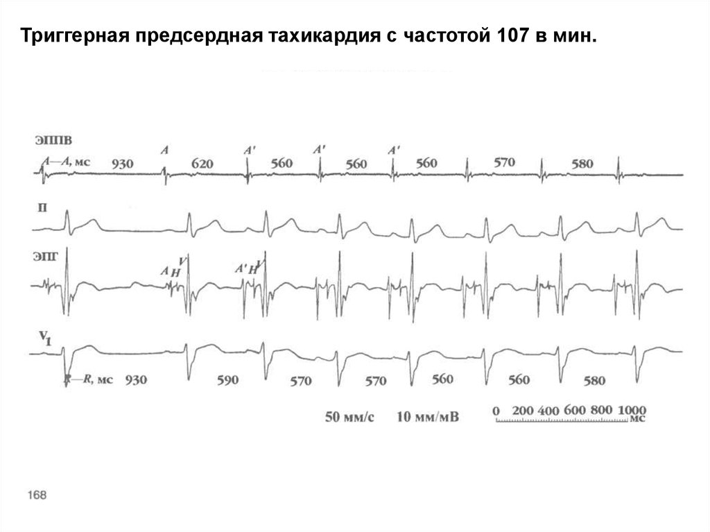 Предсердная тахикардия. Блокированная предсердная тахикардия. Очаговая предсердная тахикардия. Полиморфная предсердная тахикардия. Автоматическая предсердная тахикардия.