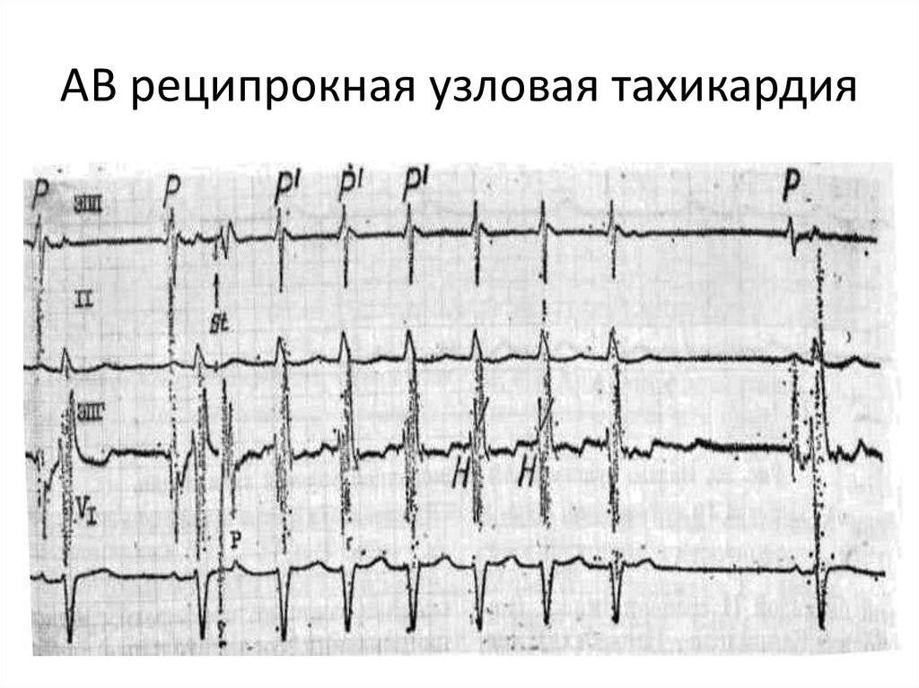 Тахикардия у ребенка