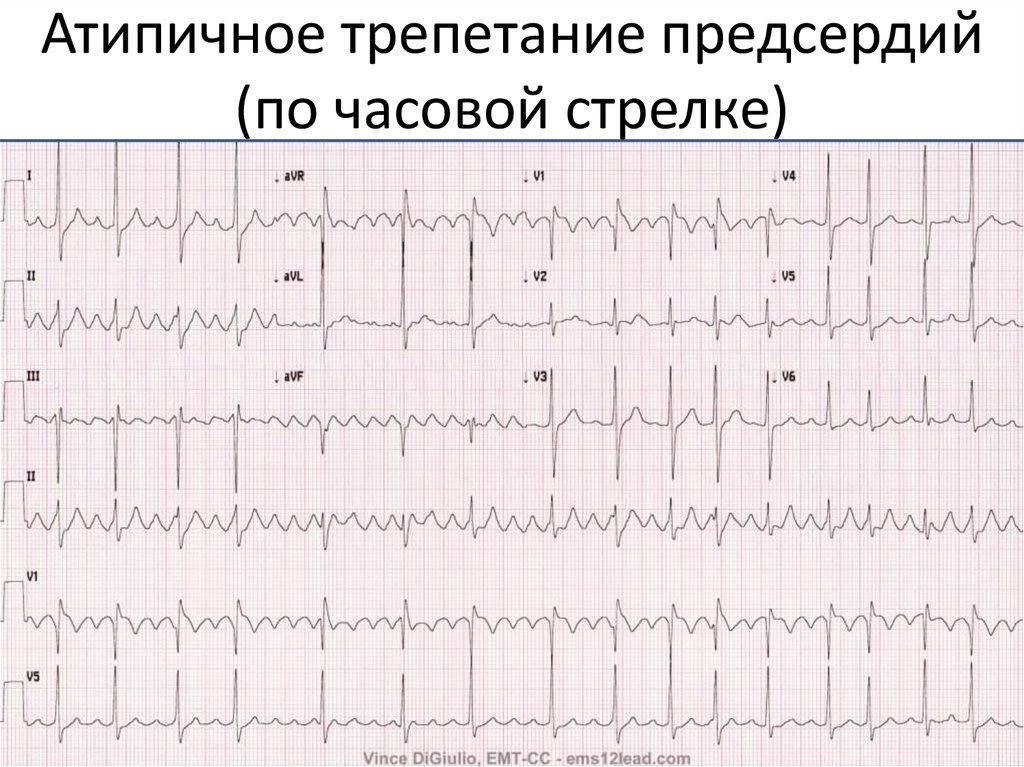 Тахикардия неуточненная карта вызова