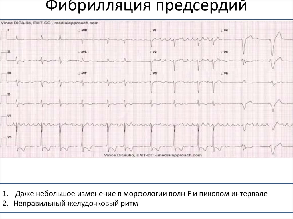 1 наджелудочковая экстрасистола