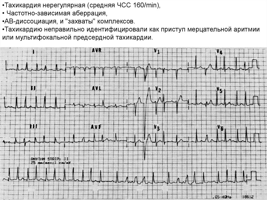 Предсердная тахикардия. Многоочаговая предсердная тахикардия на ЭКГ. АВ тахикардия суправентрикулярная ЭКГ. Наджелудочковая тахикардия с АВ блокадой 2 степени. Предсердная тахикардия с аберрантным проведением на ЭКГ.