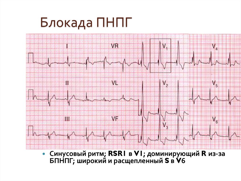 Ребенку год неполная блокада пнпг