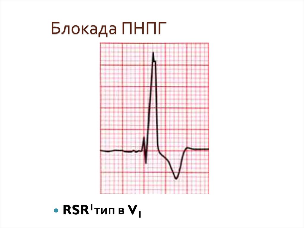 Блокада пнпг. Блокада типа RSR. Блокада ПНПГ пейсмекер. Неполная блокада ПНПГ 12 лет. Гл; на фоне блокады ПНПГ.