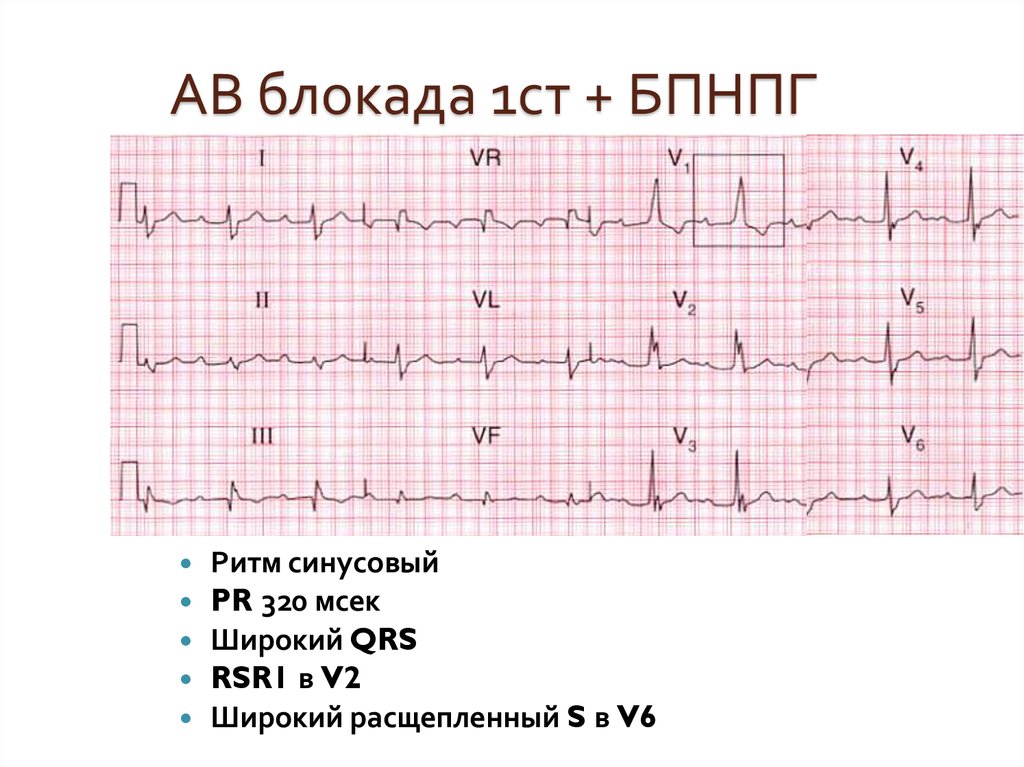 Ав блокады на экг картинки