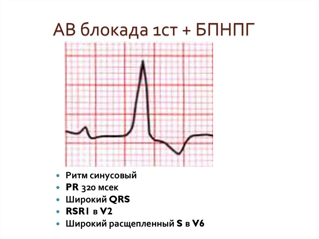 Блокада правой ножки мкб. Ab блокада 1 ст. Расщепленный QRS. Блокада 01ст. Av блокада 1 ст.